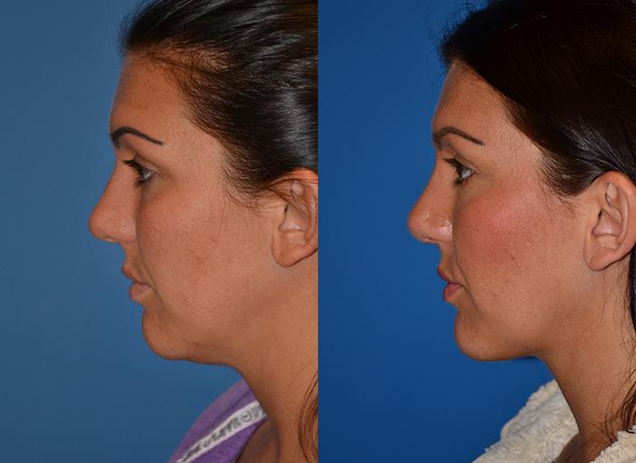Laser Assisted Weekend Neck Lift Photos Melbourne, FL Patient 28402